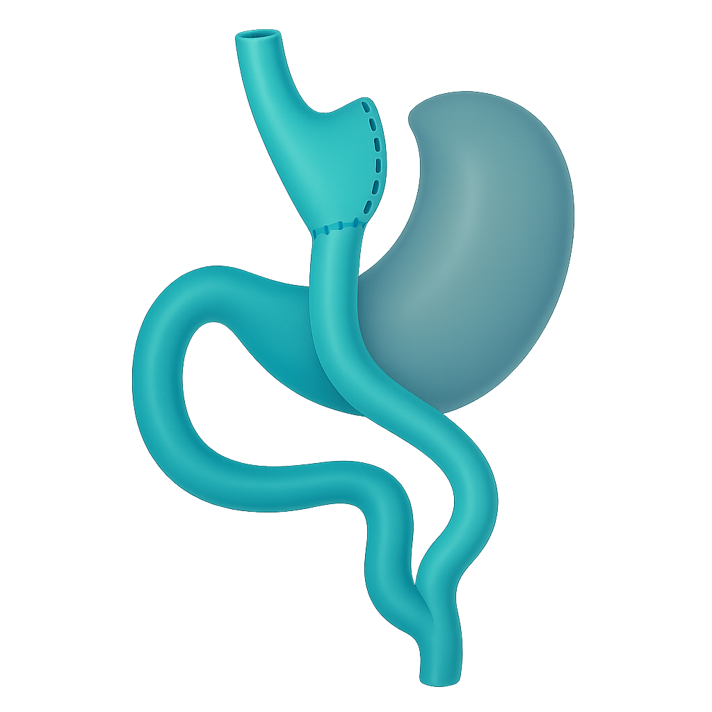 cirugia bariatrica bypass y sleeve o manga gastrica