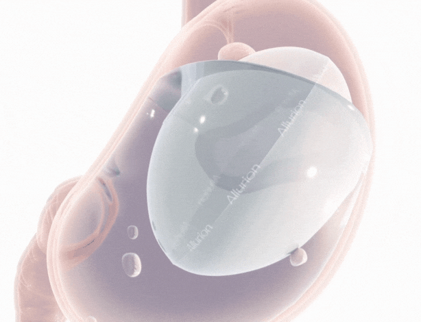 gif ballon allurion dans estomac